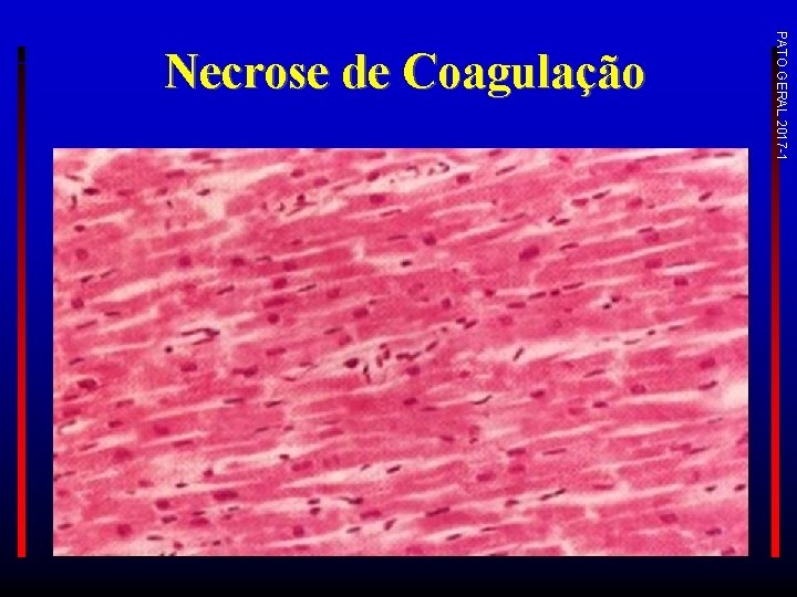 PATO GERAL 2017 -1 Necrose de Coagulação 