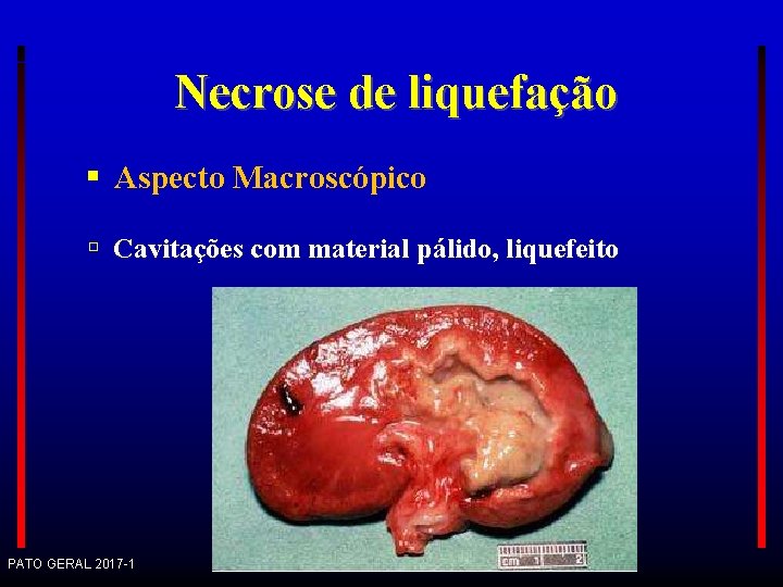 Necrose de liquefação Aspecto Macroscópico Cavitações com material pálido, liquefeito PATO GERAL 2017 -1