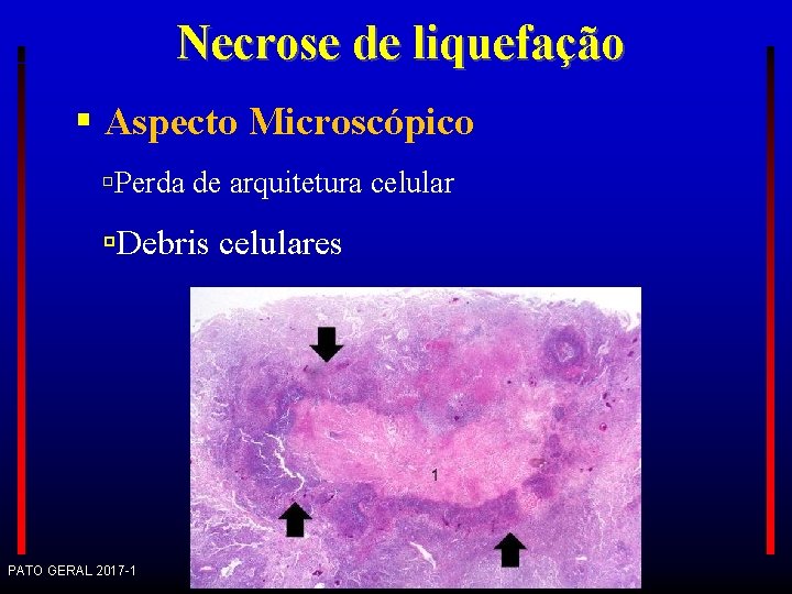 Necrose de liquefação Aspecto Microscópico Perda de arquitetura celular Debris celulares PATO GERAL 2017