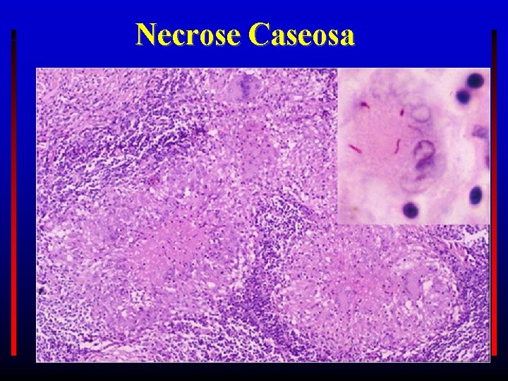 Necrose Caseosa PATO GERAL 2017 -1 