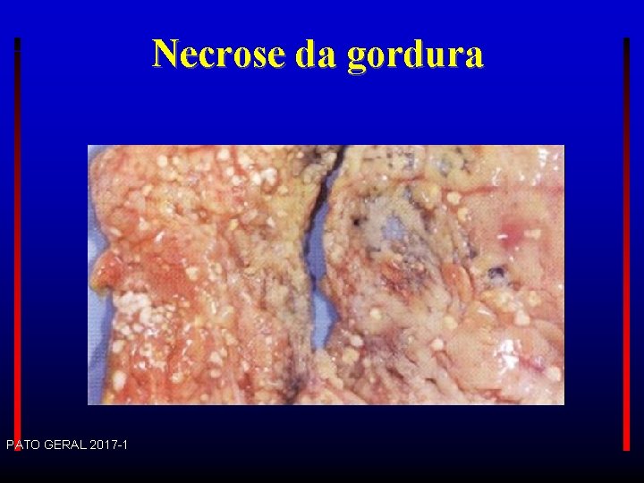 Necrose da gordura PATO GERAL 2017 -1 