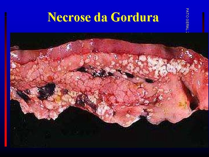 PATO GERAL 2017 -1 Necrose da Gordura 