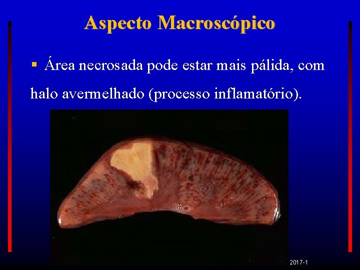 Aspecto Macroscópico Área necrosada pode estar mais pálida, com halo avermelhado (processo inflamatório). PATO