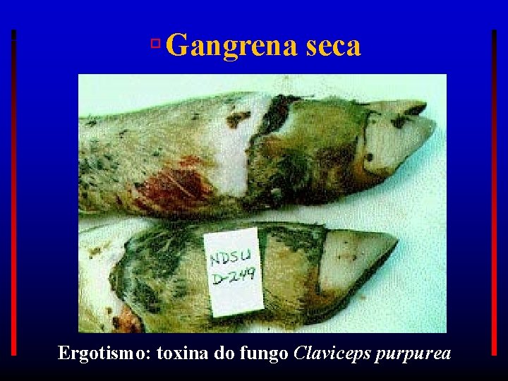  Gangrena seca Ergotismo: toxina do fungo Claviceps purpurea 