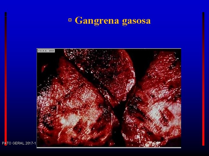  Gangrena gasosa PATO GERAL 2017 -1 