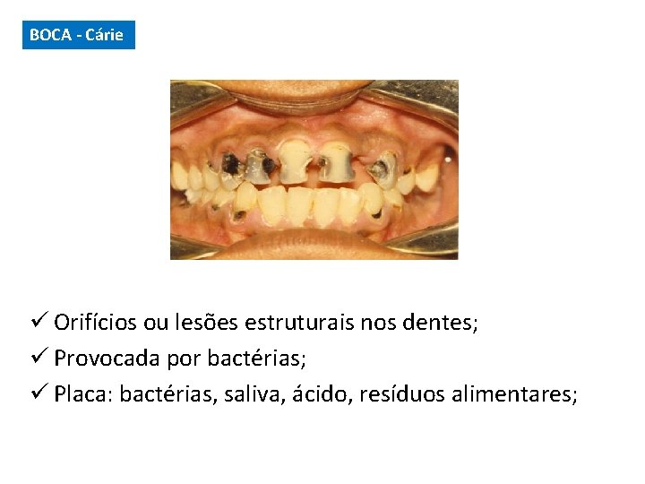 BOCA - Cárie ü Orifícios ou lesões estruturais nos dentes; ü Provocada por bactérias;