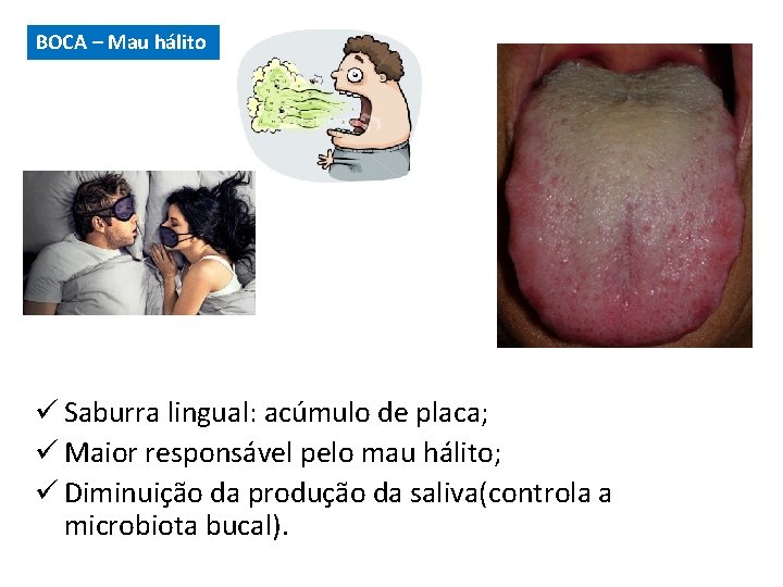 BOCA – Mau hálito ü Saburra lingual: acúmulo de placa; ü Maior responsável pelo