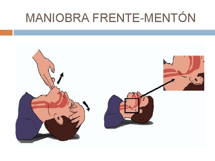 MANIOBRA FRENTE-MENTÓN 