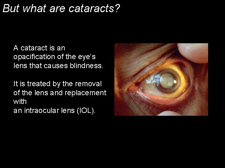 But what are cataracts? A cataract is an opacification of the eye’s lens that