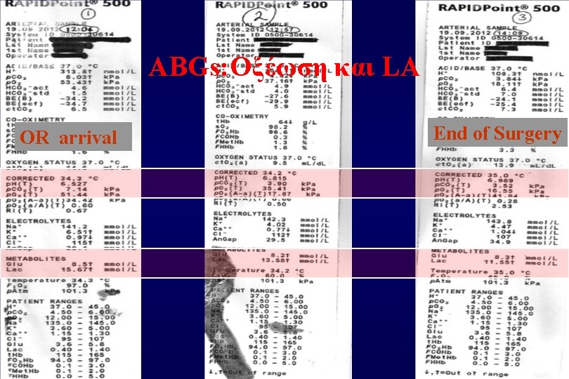 ABGs: Οξέωση και LA OR arrival End of Surgery 