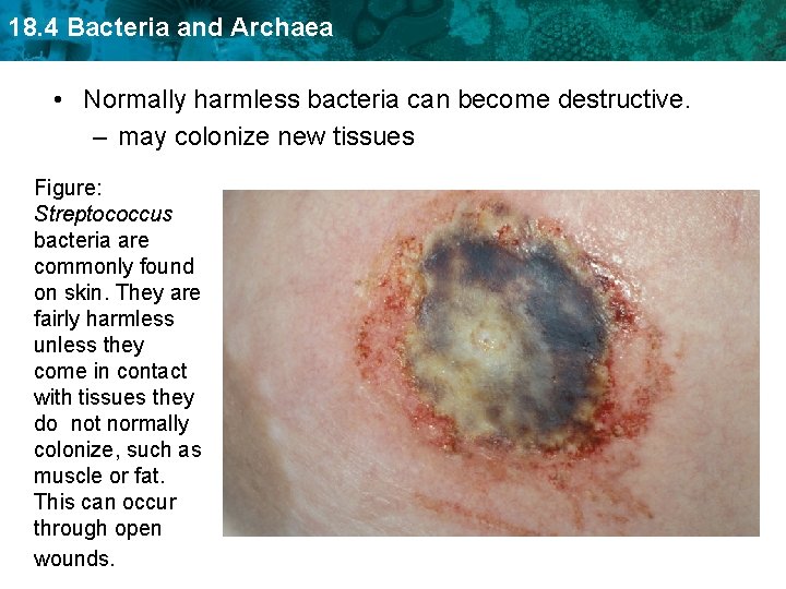 18. 4 Bacteria and Archaea • Normally harmless bacteria can become destructive. – may