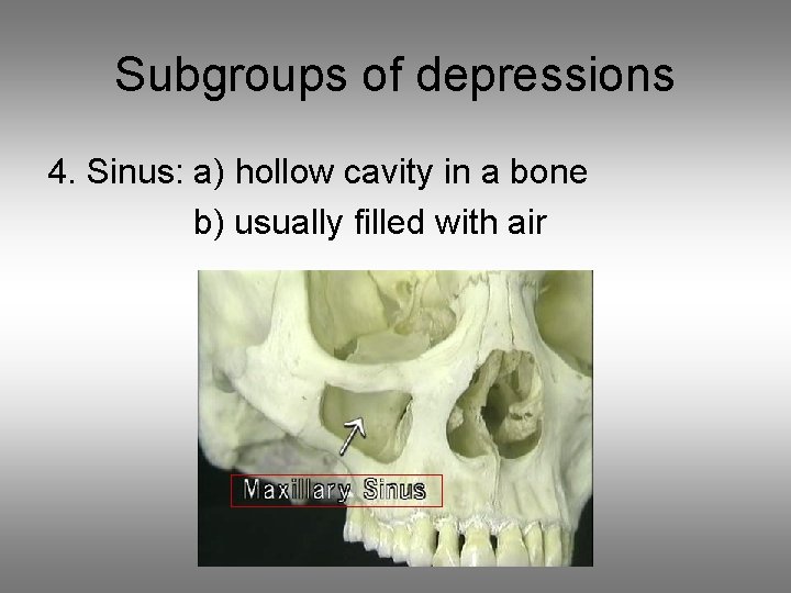 Subgroups of depressions 4. Sinus: a) hollow cavity in a bone b) usually filled