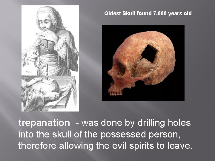 Oldest Skull found 7, 000 years old trepanation - was done by drilling holes