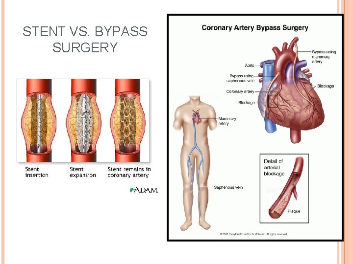 STENT VS. BYPASS SURGERY 