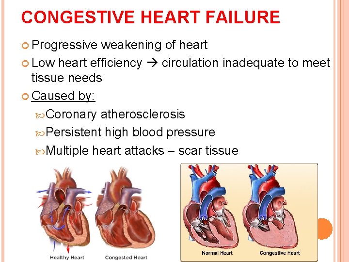 CONGESTIVE HEART FAILURE Progressive weakening of heart Low heart efficiency circulation inadequate to meet