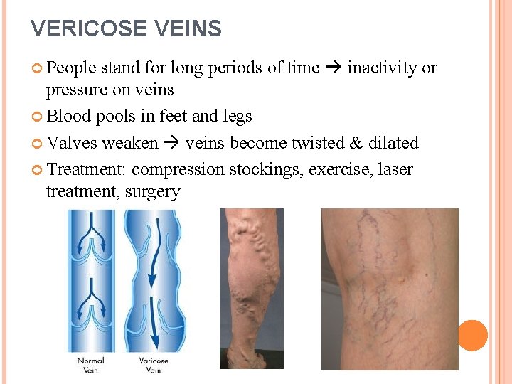 VERICOSE VEINS stand for long periods of time inactivity or pressure on veins Blood