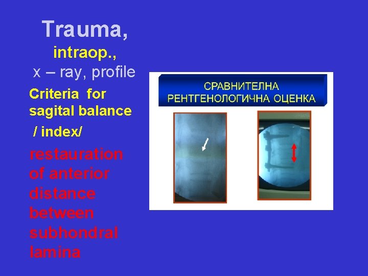 Trauma, intraop. , x – ray, profile Criteria for sagital balance / index/ restauration