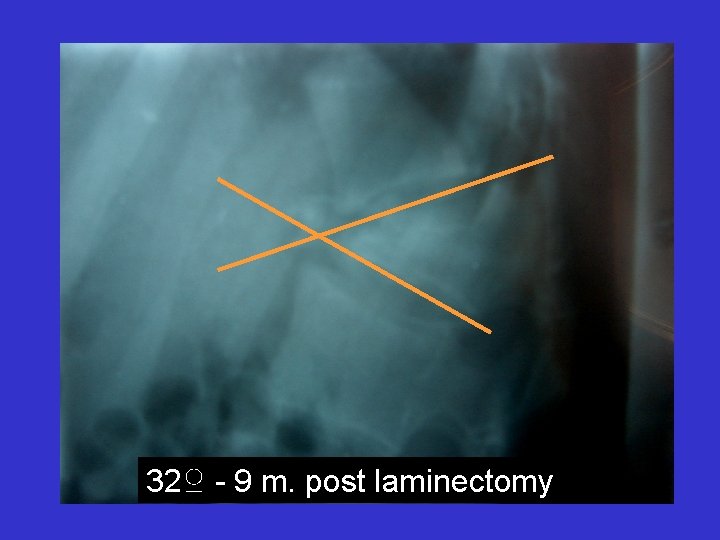 32♀ - 9 m. post laminectomy 