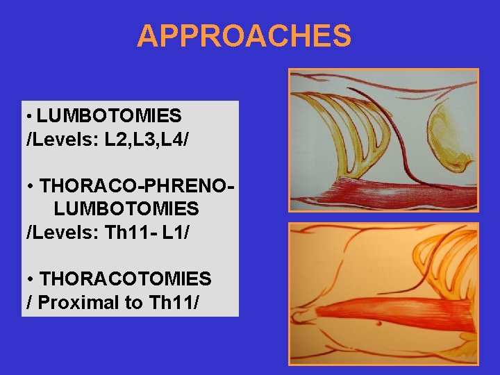 APPROACHES • LUMBOTOMIES /Levels: L 2, L 3, L 4/ • THORACO-PHRENOLUMBOTOMIES /Levels: Th