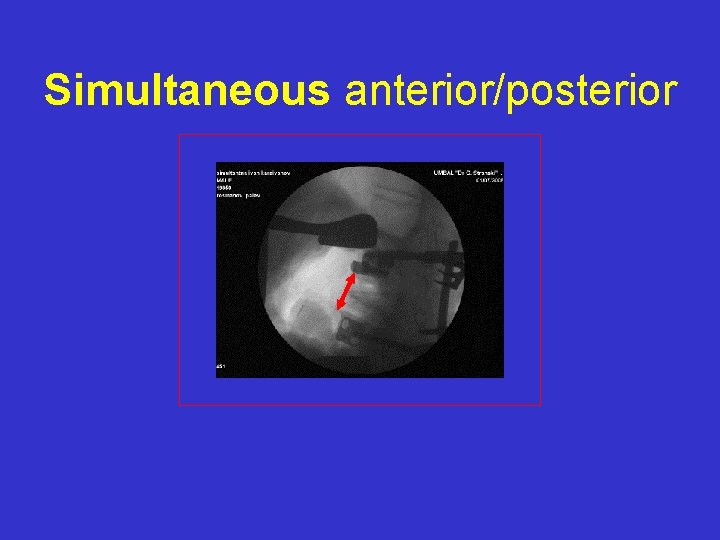 Simultaneous anterior/posterior 