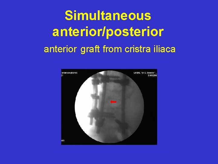 Simultaneous anterior/posterior anterior graft from cristra iliaca 