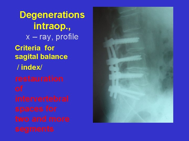 Degenerations intraop. , x – ray, profile Criteria for sagital balance / index/ restauration