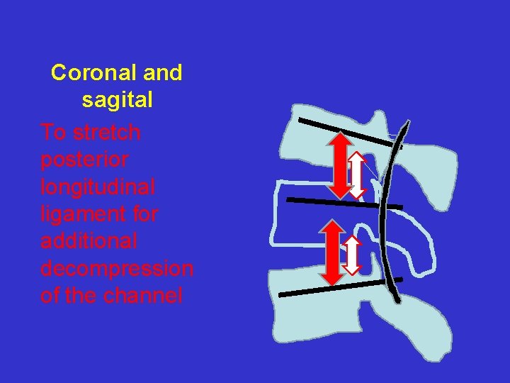 Coronal and sagital To stretch posterior longitudinal ligament for additional decompression of the channel