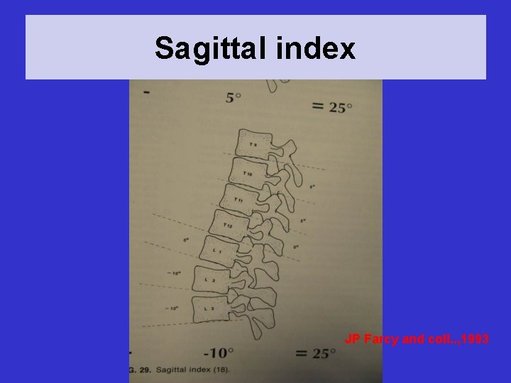 Sagittal index JP Farcy and coll. . , 1993 