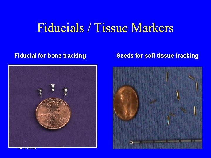 Fiducials / Tissue Markers Fiducial for bone tracking 10/17/2021 Seeds for soft tissue tracking