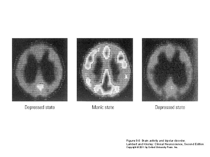 Figure 9. 6 Brain activity and bipolar disorder. Lambert and Kinsley: Clinical Neuroscience, Second Figure 9. 6 Brain activity and bipolar disorder. Lambert and Kinsley: Clinical Neuroscience, Second