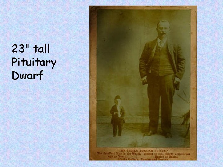 23" tall Pituitary Dwarf 