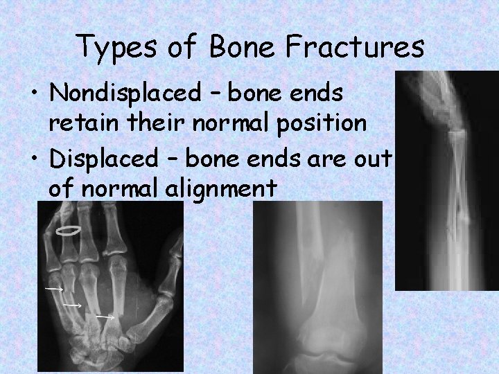 Types of Bone Fractures • Nondisplaced – bone ends retain their normal position •
