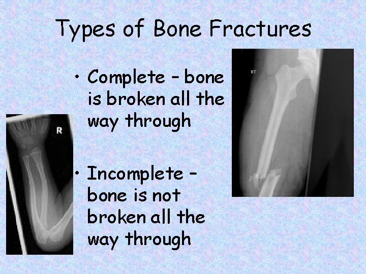 Types of Bone Fractures • Complete – bone is broken all the way through