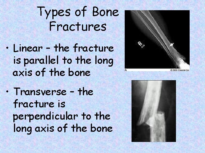 Types of Bone Fractures • Linear – the fracture is parallel to the long