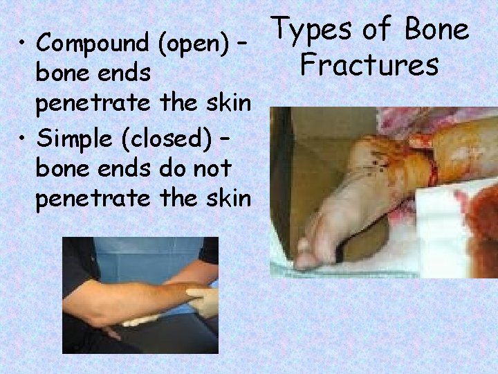 Types of Bone • Compound (open) – Fractures bone ends penetrate the skin •