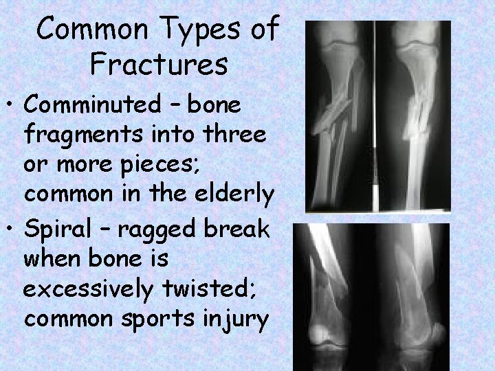 Common Types of Fractures • Comminuted – bone fragments into three or more pieces;