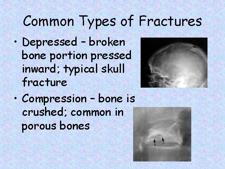 Common Types of Fractures • Depressed – broken bone portion pressed inward; typical skull