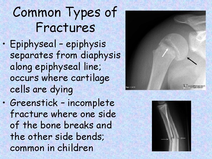 Common Types of Fractures • Epiphyseal – epiphysis separates from diaphysis along epiphyseal line;