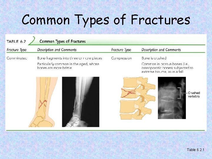 Common Types of Fractures Table 6. 2. 1 