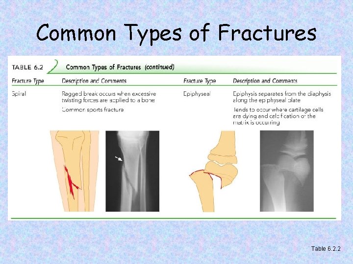 Common Types of Fractures Table 6. 2. 2 