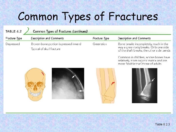 Common Types of Fractures Table 6. 2. 3 