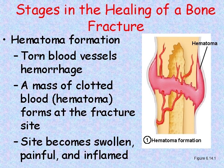 Stages in the Healing of a Bone Fracture • Hematoma formation – Torn blood