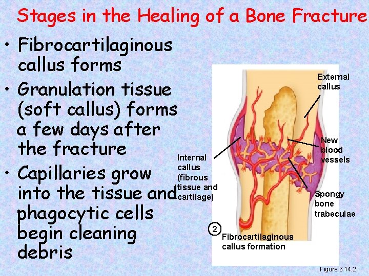 Stages in the Healing of a Bone Fracture • Fibrocartilaginous callus forms • Granulation
