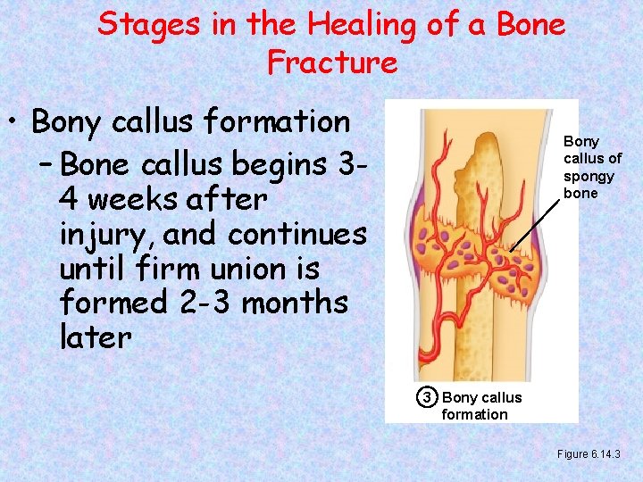 Stages in the Healing of a Bone Fracture • Bony callus formation – Bone