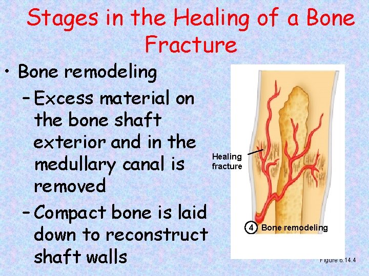 Stages in the Healing of a Bone Fracture • Bone remodeling – Excess material