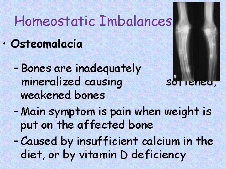 Homeostatic Imbalances • Osteomalacia – Bones are inadequately mineralized causing softened, weakened bones –