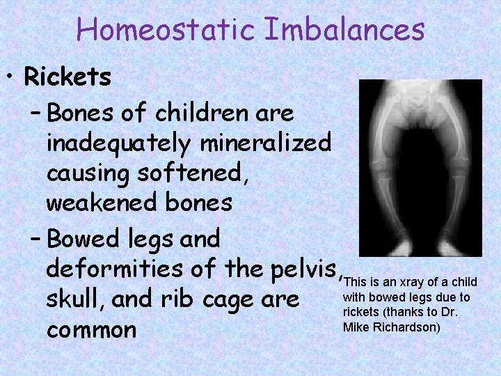 Homeostatic Imbalances • Rickets – Bones of children are inadequately mineralized causing softened, weakened