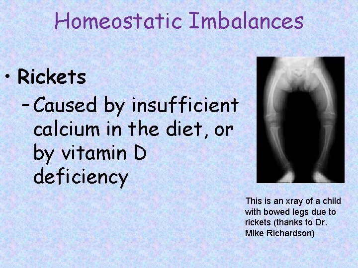 Homeostatic Imbalances • Rickets – Caused by insufficient calcium in the diet, or by