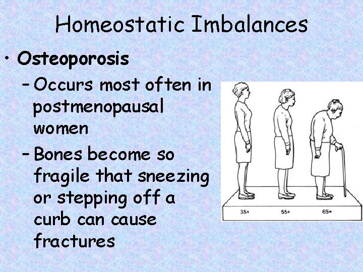 Homeostatic Imbalances • Osteoporosis – Occurs most often in postmenopausal women – Bones become