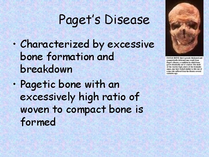 Paget’s Disease • Characterized by excessive bone formation and breakdown • Pagetic bone with